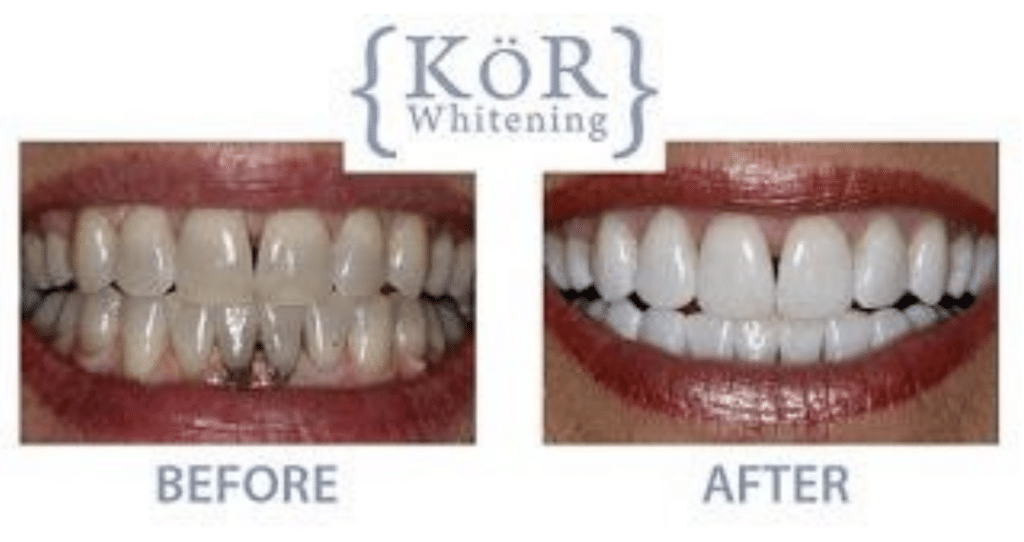 KÖR Teeth Whitening in Mechanicsburg PA