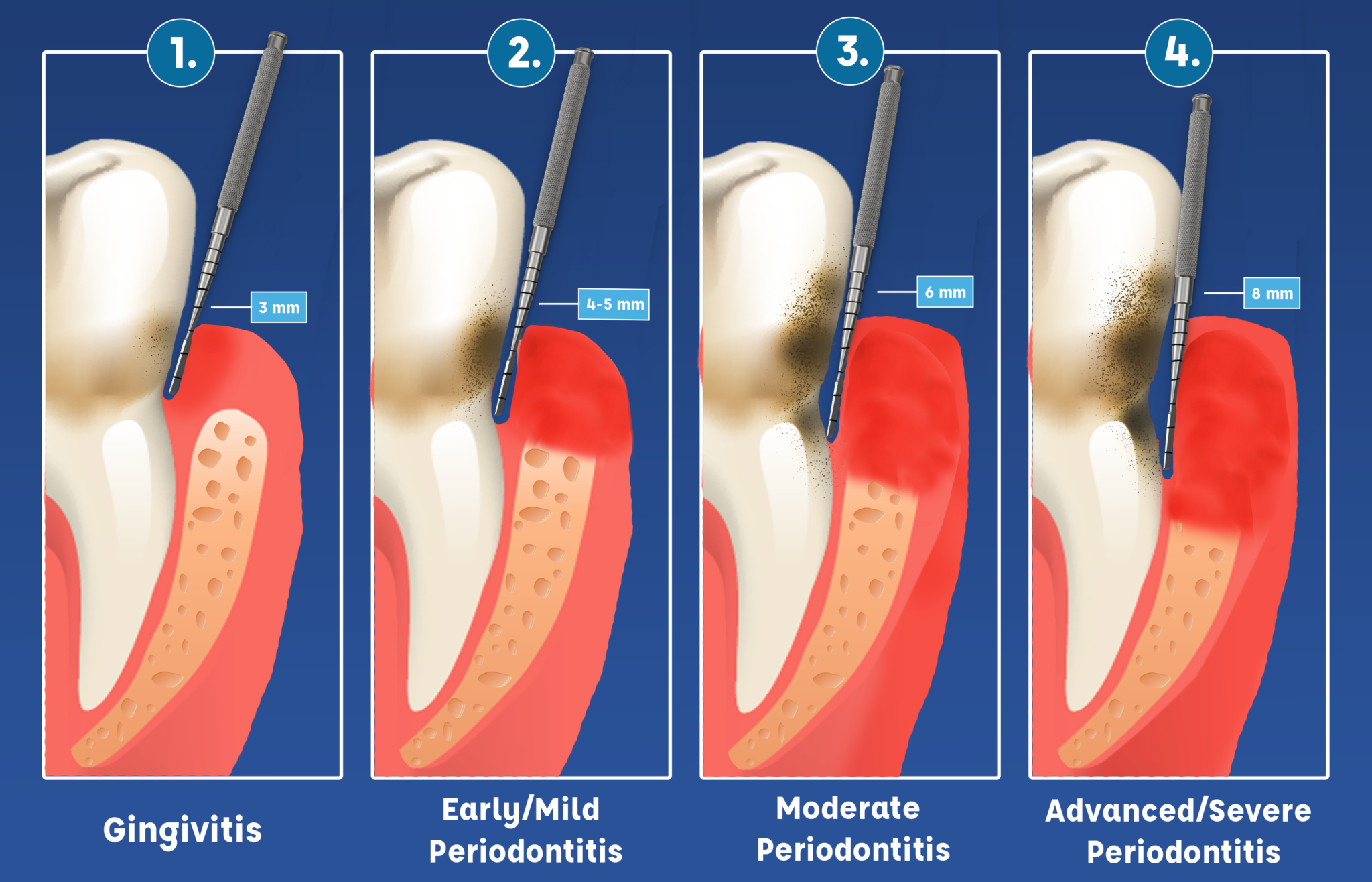 What is Gingivitis? Rother Dental